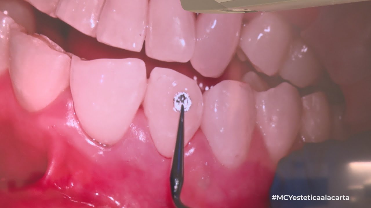 Las joyas dentales: La nueva moda para personalizar nuestra sonrisa