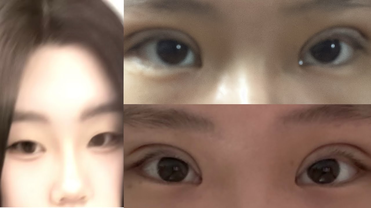 부분절개 + 지방제거 쌍수 브이로그