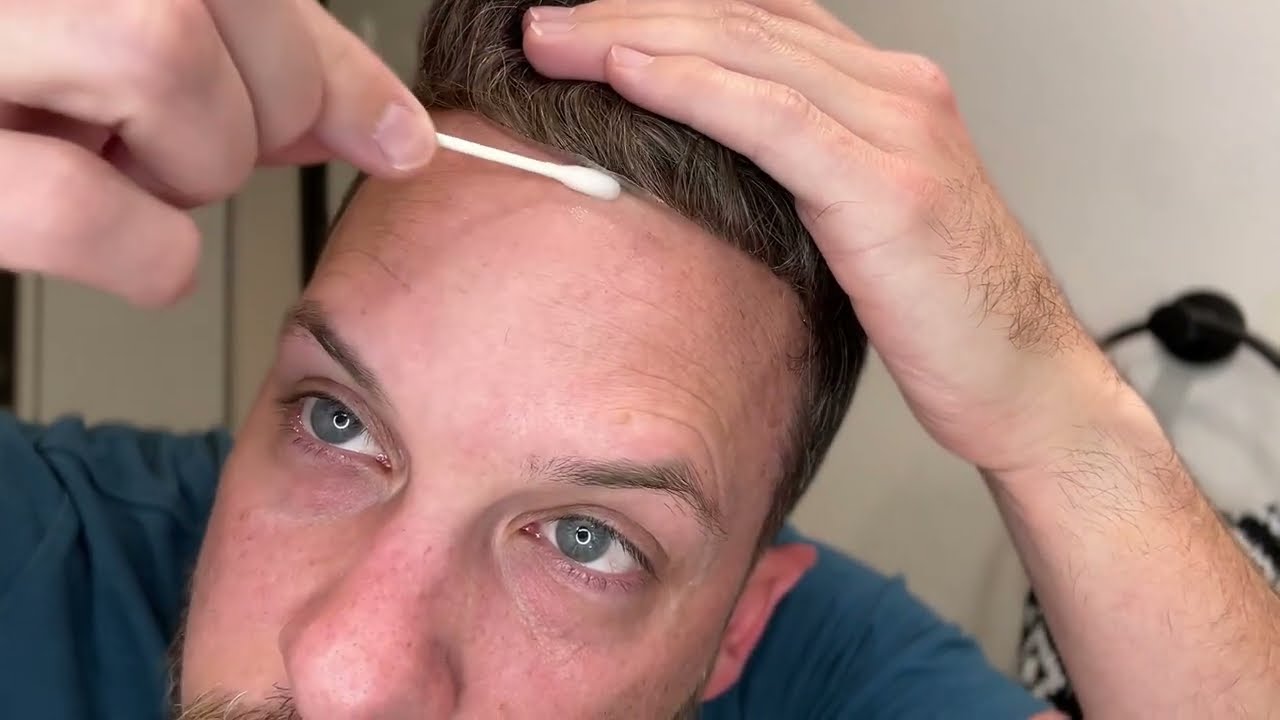 Front Hairline Lifting? Quick Fix for Hair System Wearers