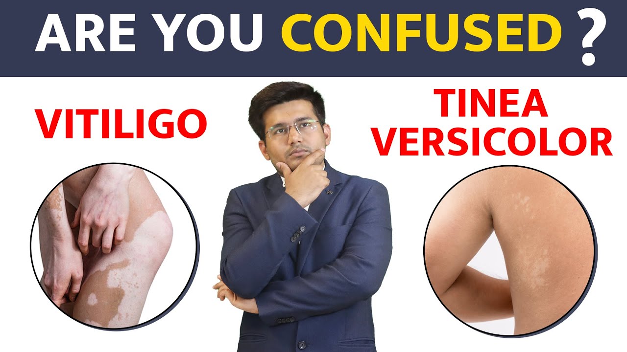 Is it Vitiligo or Tinea Versicolor | Bharat Homeopathy