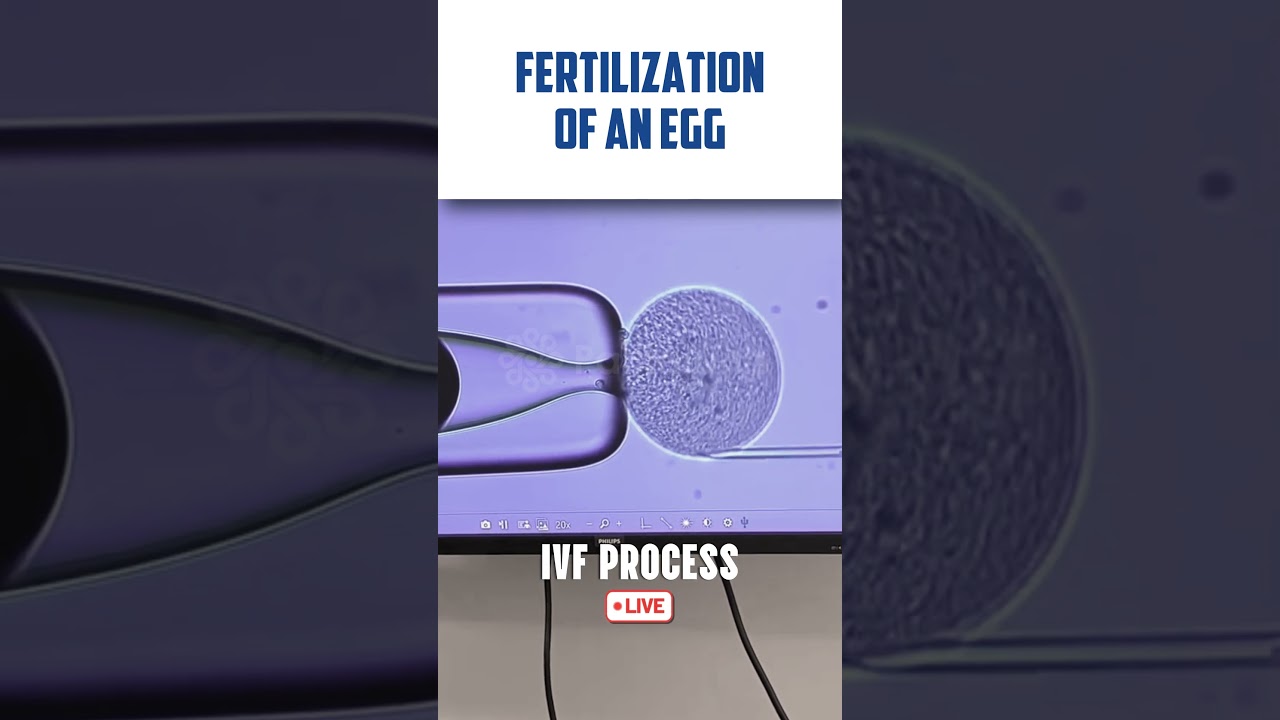 IVF transfer procedure LIVE VIDEO 🔴 Fertilization of Egg & Sperm in Human #fertilization #ivfprocess