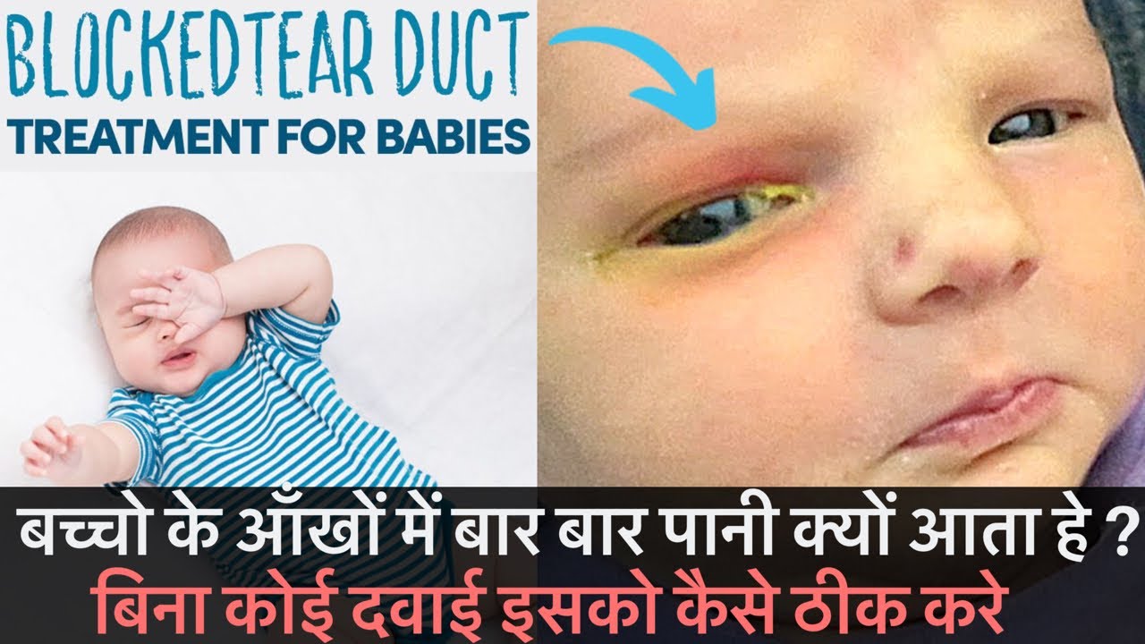 इतना करोगे तो कभी भी आँख से पानी नहीं आएगा | How to treat recurrent eye infection in baby