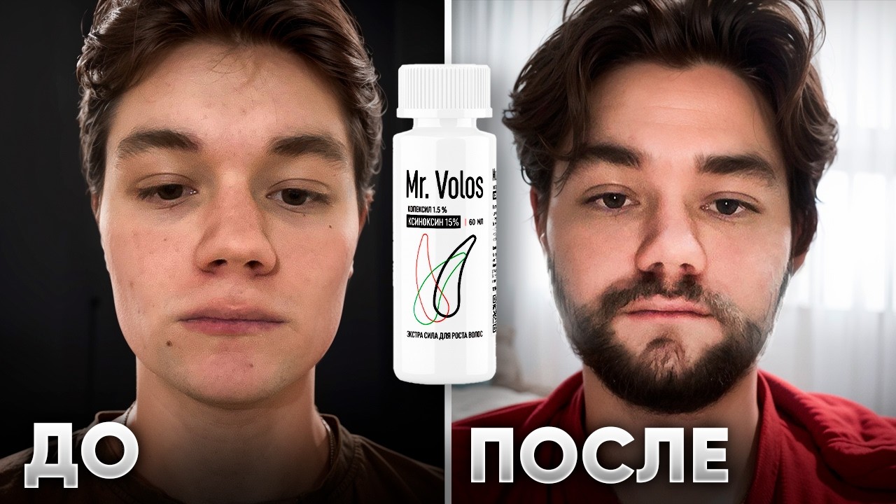 ОТРАСТИЛ БОРОДУ ЛЕСНИКА с НУЛЯ. Результаты применения Mr.VOLOS 5% и 15%