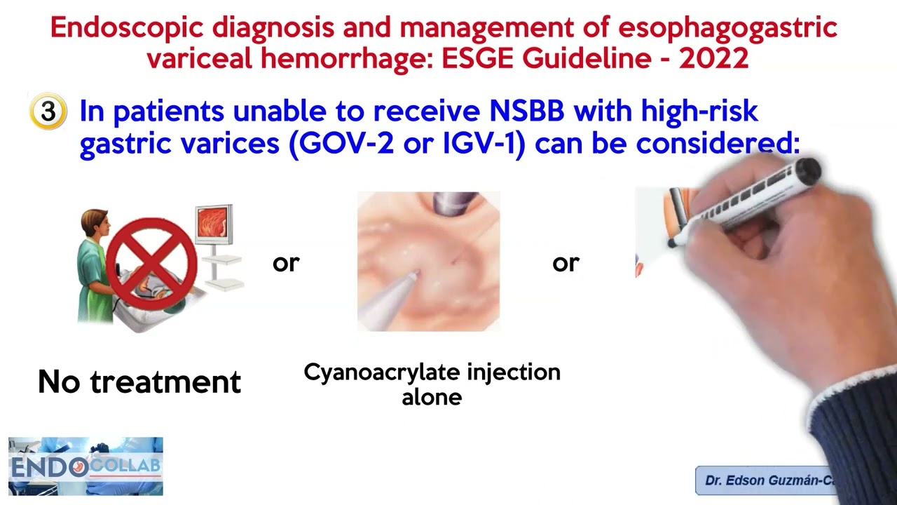 Endoscopic diagnosis and management of esophagogastricvariceal hemorrhage: ESGE Guideline - 2022