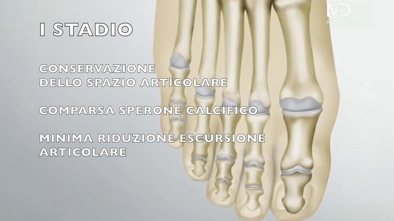 Alluce rigido sintomi e patologia