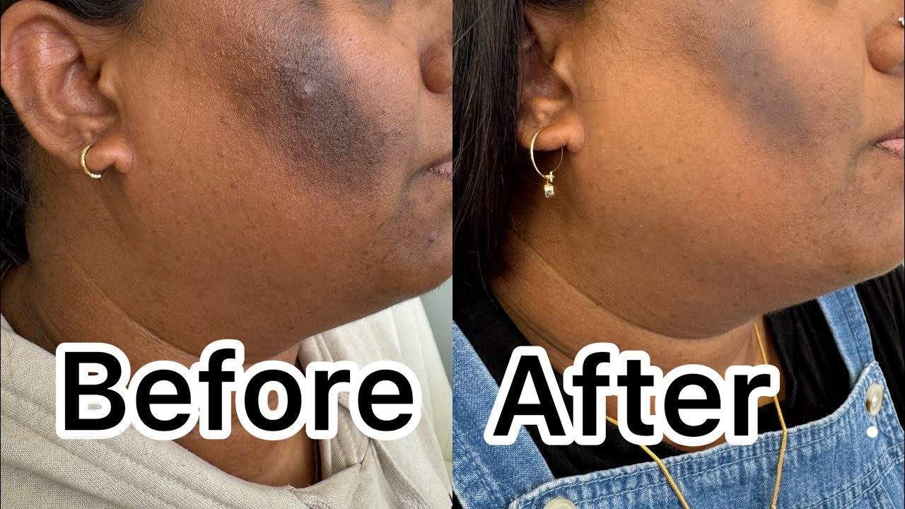 Melanostop tranex peel with depigmentation solution microneedling. 