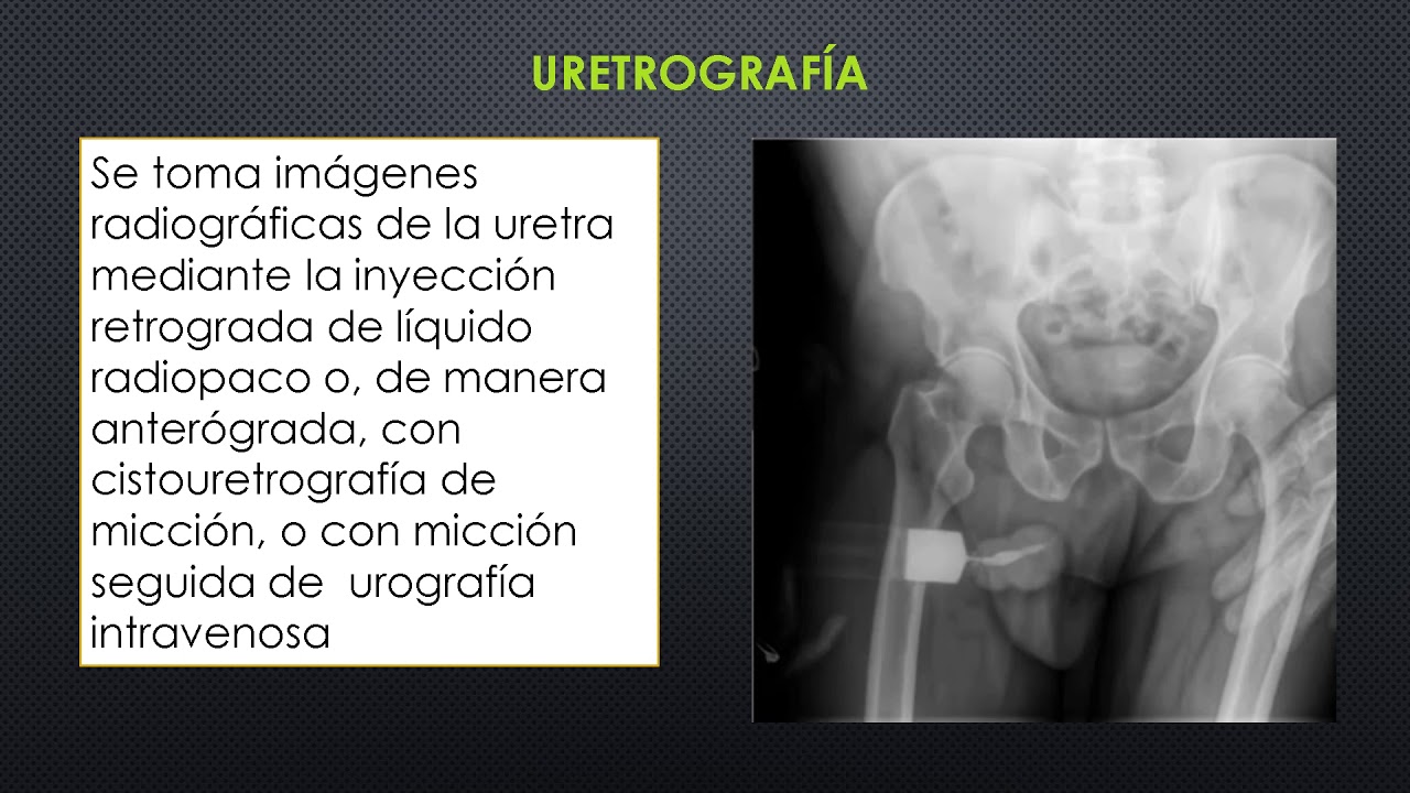 CISTOGRAFÍA Y URETROGRAFÍA