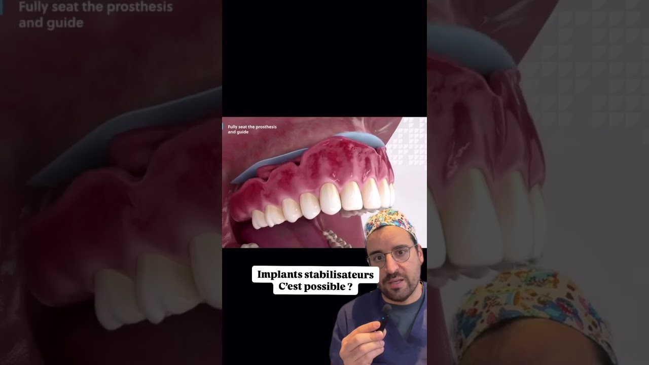 IMPLANT dentaire : comment STABILISER proth&egrave;se ?