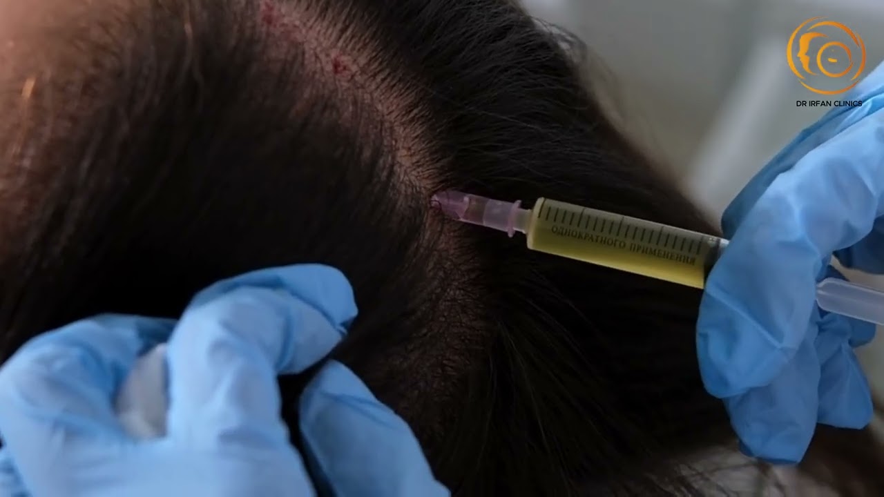 Exosomes Treatment at Dr. Irfan Clinics