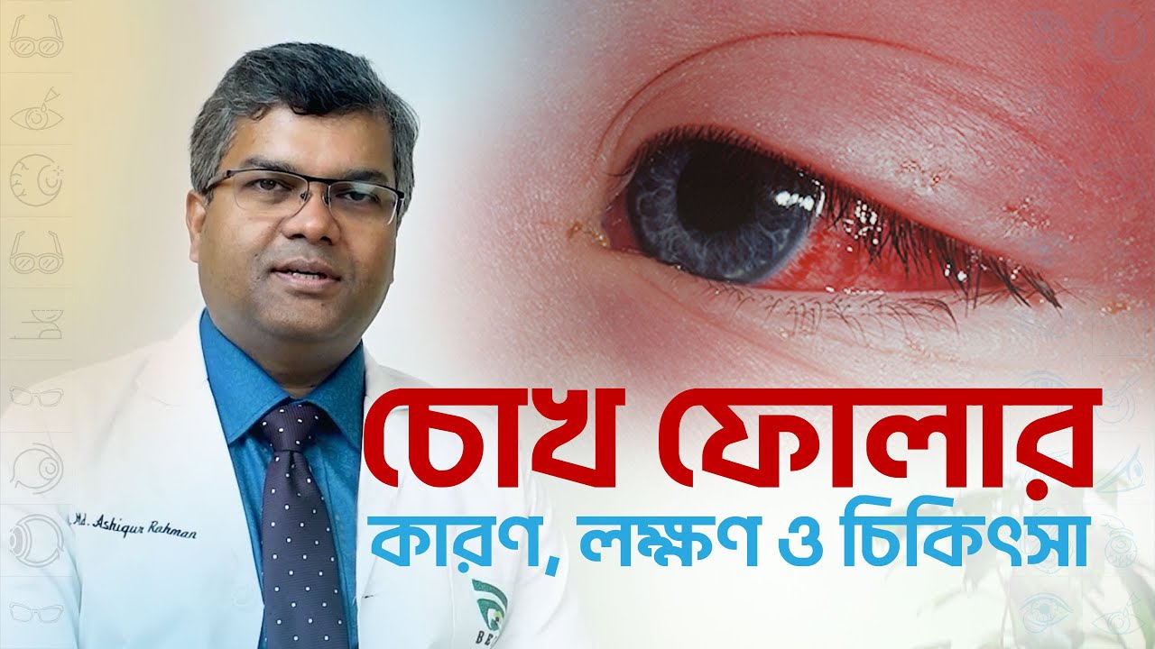 শিশুদের চোখ ফুলে যাওয়ার কারণ, লক্ষণ ও চিকিৎসা II @𝗗𝚛. 𝗔𝚜𝚑𝚒𝚚𝚞𝚛 𝗥𝚊𝚑𝚖𝚊𝚗 𝗔𝚔𝚊𝚗𝚍𝚊