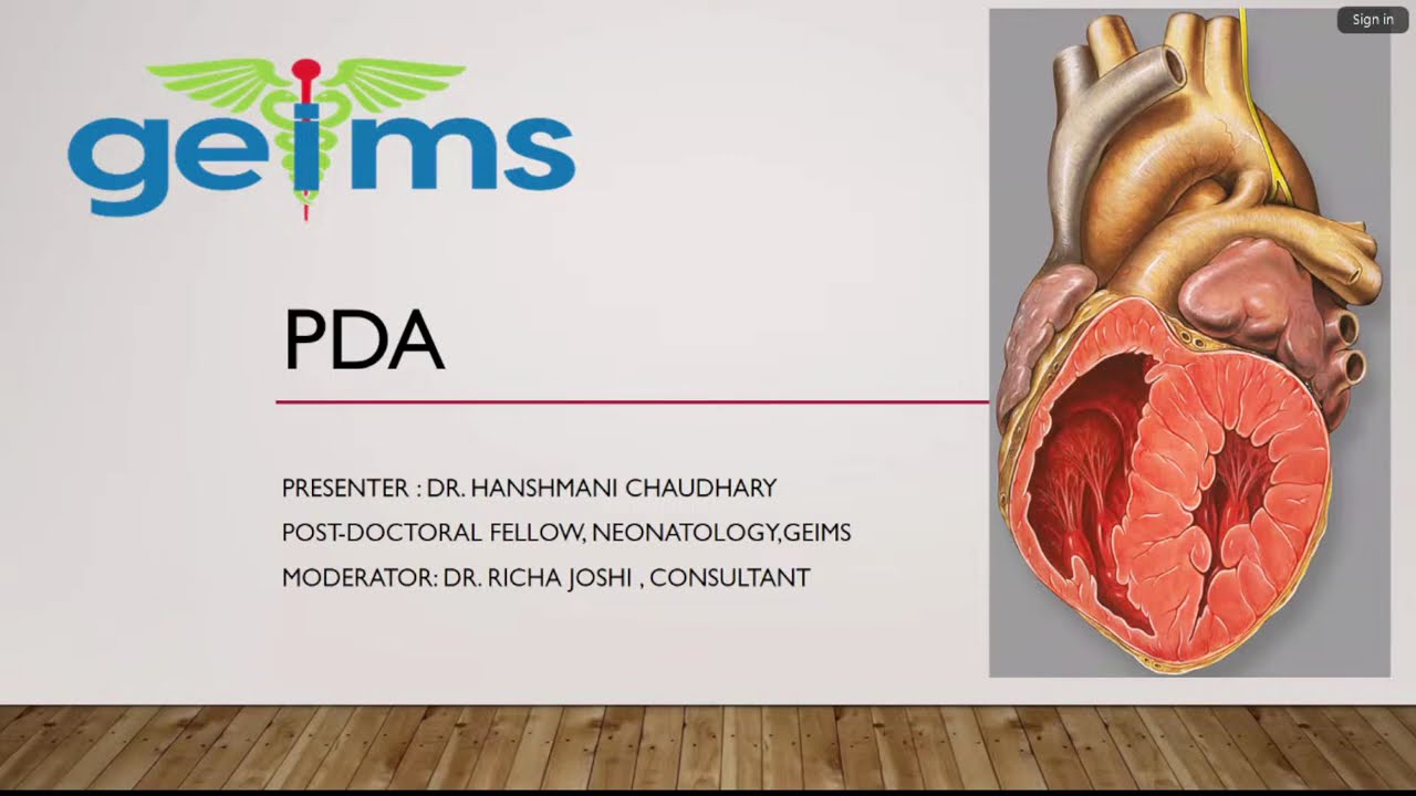 Pathophysiology and clinical features of preterm PDA | Còn ống động mạch ở trẻ