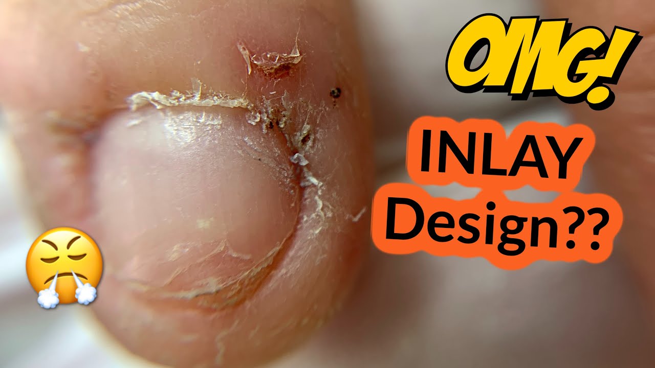 How to Fix a Severely Bitten Nails | Inlay Acrylic Design with Foil