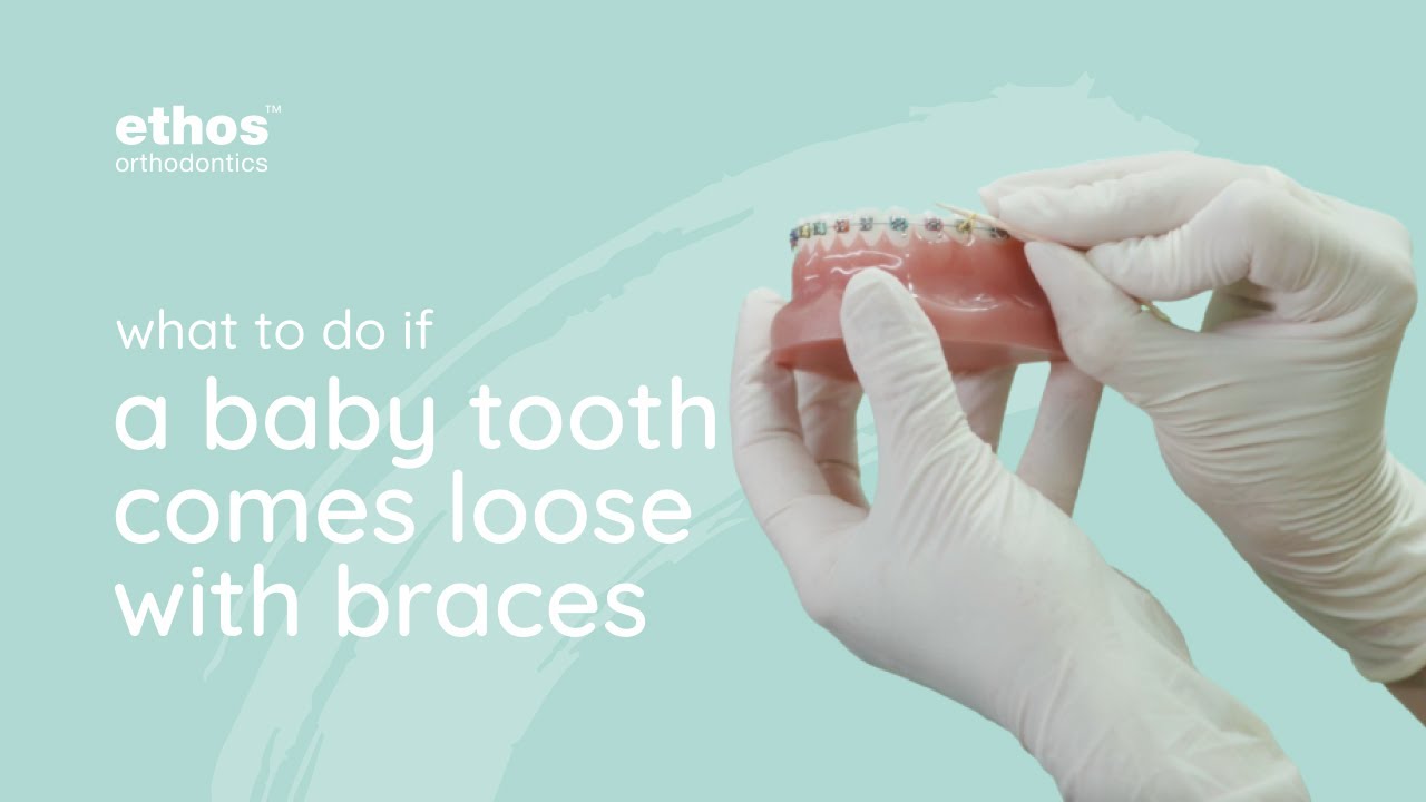 What To Do If Your Baby Tooth Comes Loose With Braces | Braces Tips