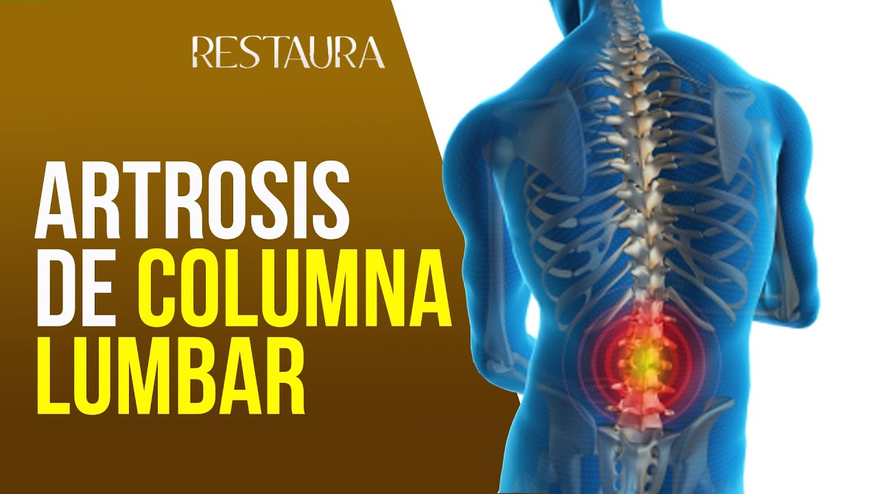 Artrosis de columna lumbar