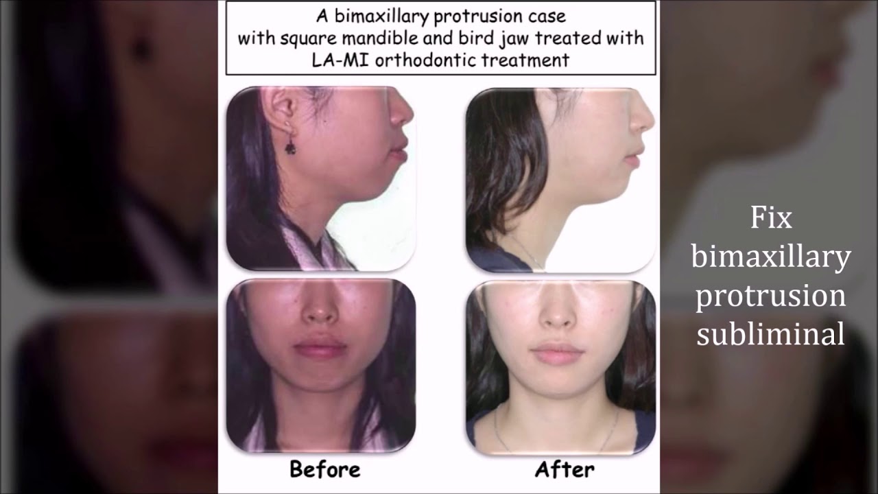 Fix Bimaxillary Protrusion Subliminal