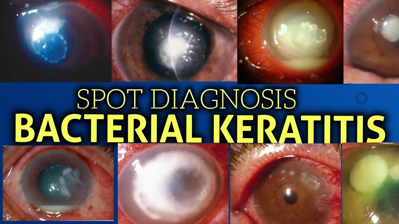 Bacterial keratitis || clinical features||