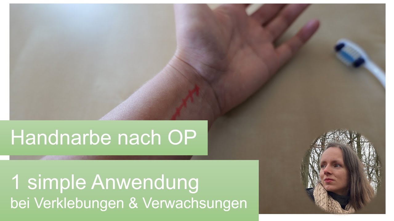 Narbe - Einfache Narbenmassage nach OP
