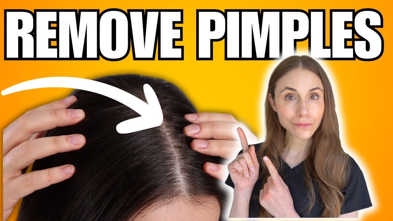 How To Remove Scalp Pimples | Folliculitis Explained