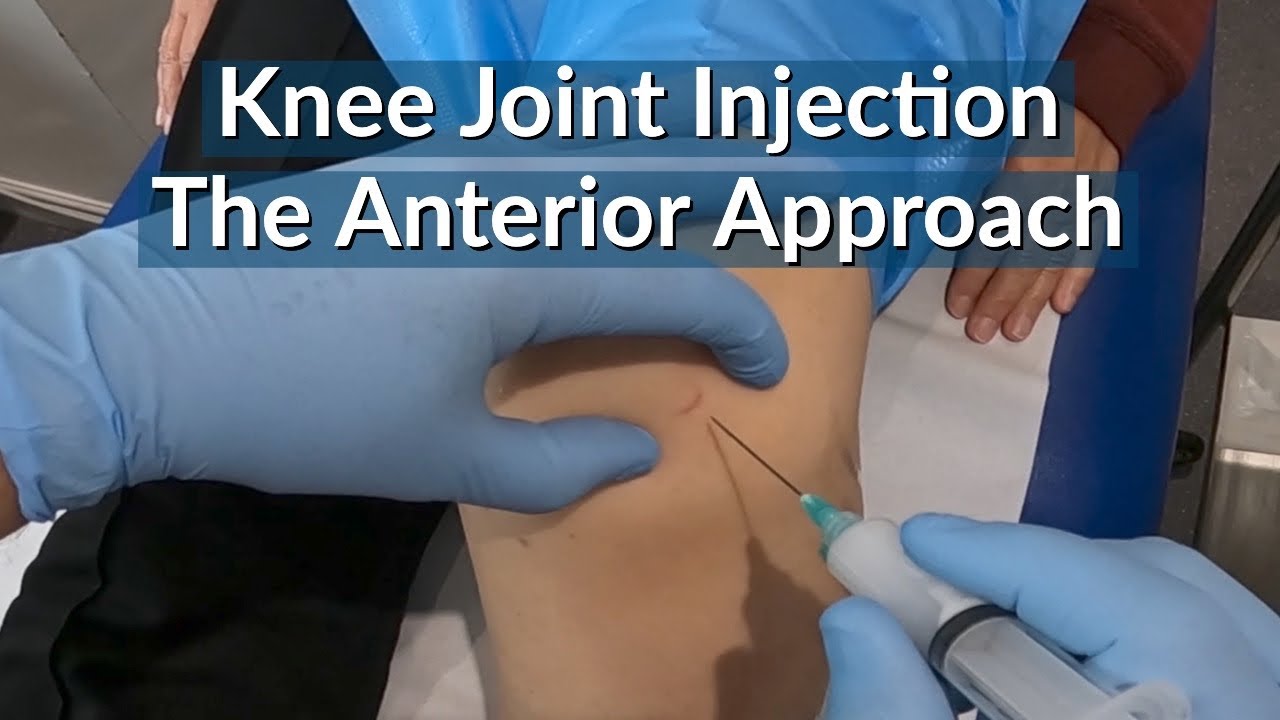 Knee Joint Injection : The Anterior Approach (eyes of the knee) - The most painless technique