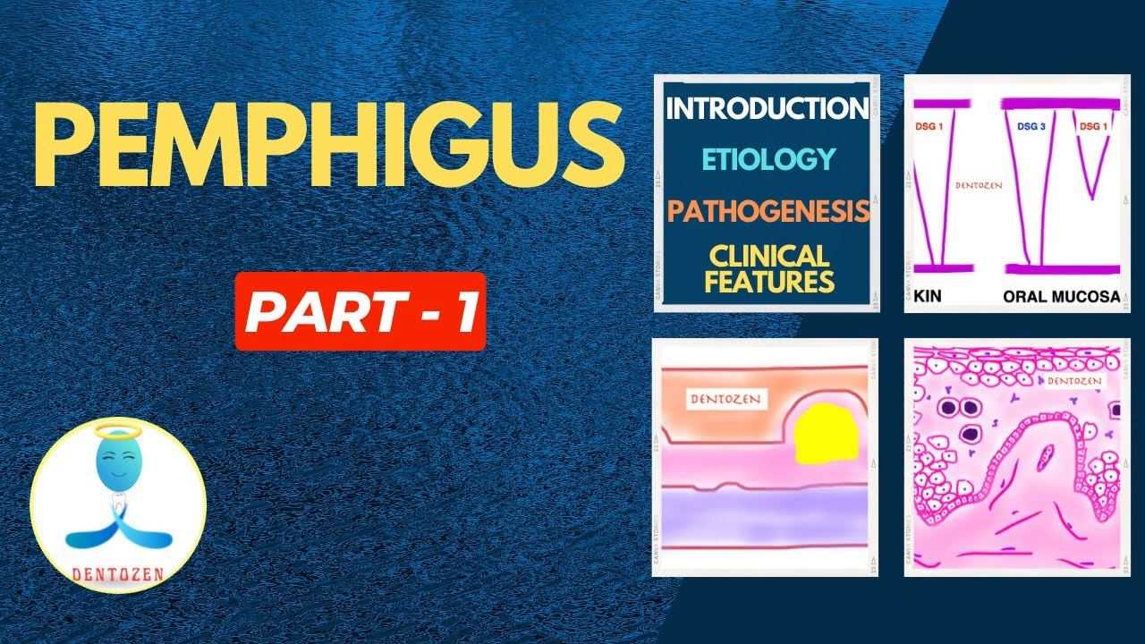 Pemphigus Part 1 | Etiology Pathogenesis Pemphigus Vulgaris | Clinical features | Nikolsky's Sign