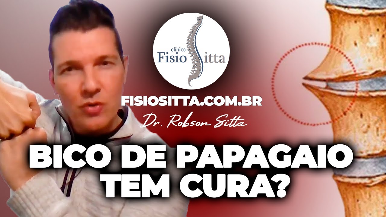 BICO DE PAPAGAIO TEM CURA? O QUE SÃO OSTEÓFITOS CAUSAS e TRATAMENTO Fisioterapia Dr. Robson Sitta