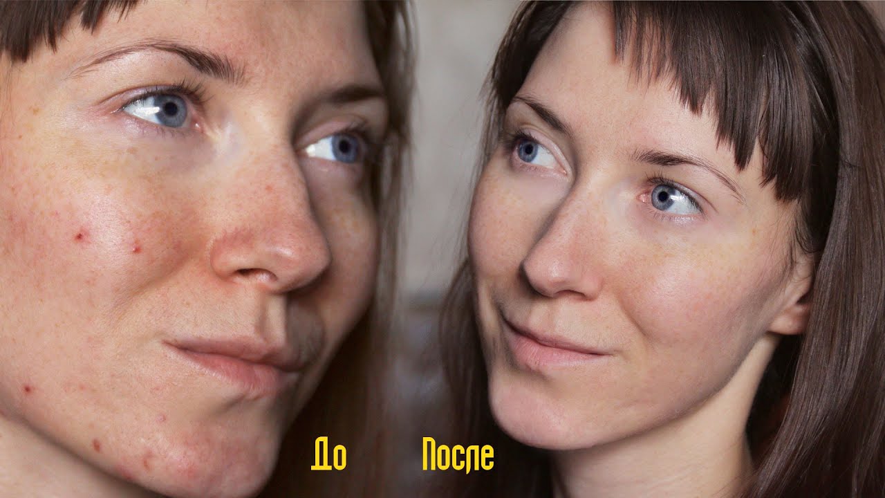 Энзимный Пилинг: Акне / Прыщи / Морщины  / Пигментые пятна