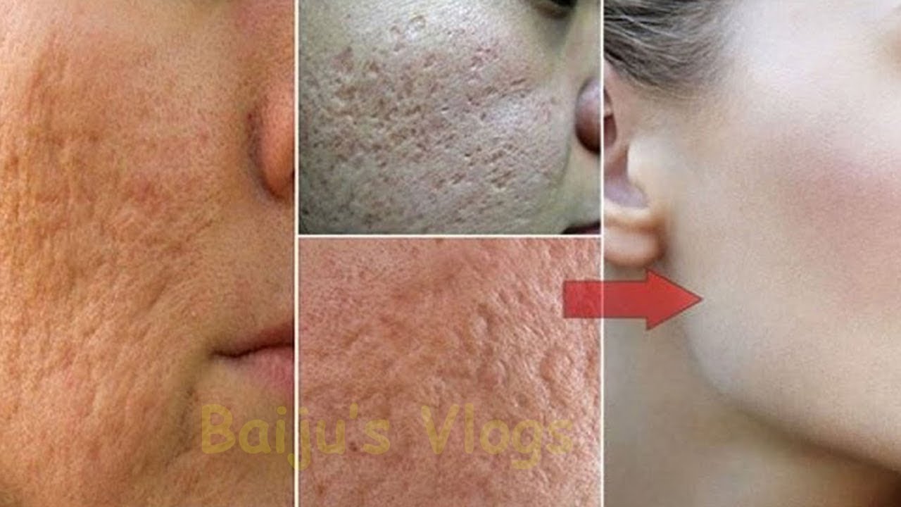 അര മണികൂര്‍ ,മുഖത്തെ കുണ്ടുകളും കുഴികളും മാറി മുഖം ക്ലീന്‍ ആകുകയും മുഖം വെളുക്കുകയും ചെയാന്‍