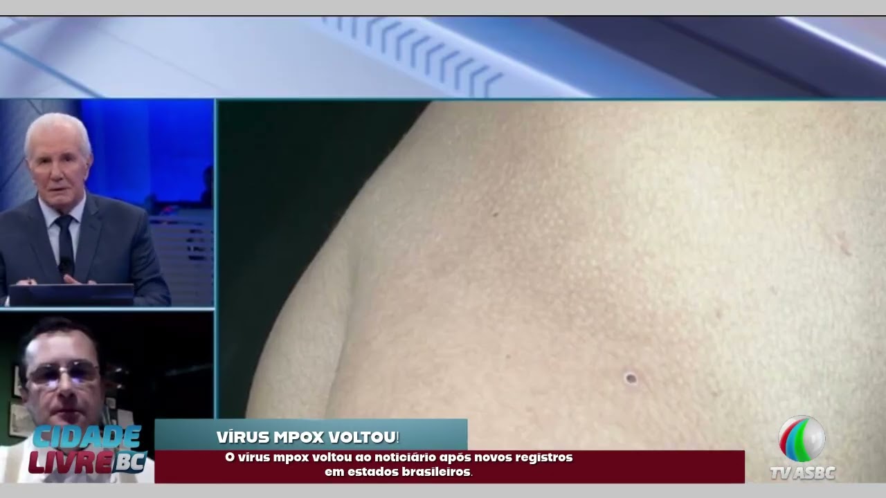 Brasil registra 46 casos de mpox em 2026   #JornaldoSBTNews