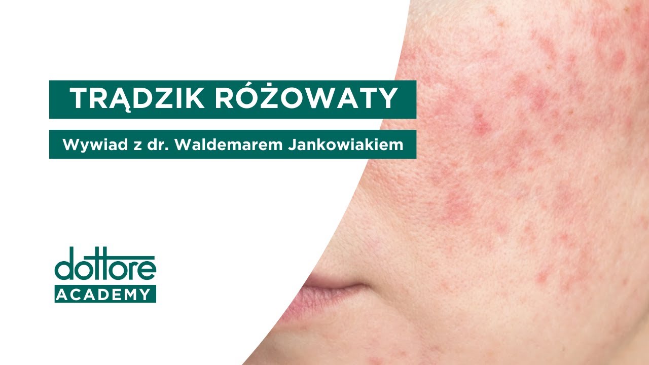 Trądzik różowaty - wywiad z dr Waldemarem Jankowiakiem