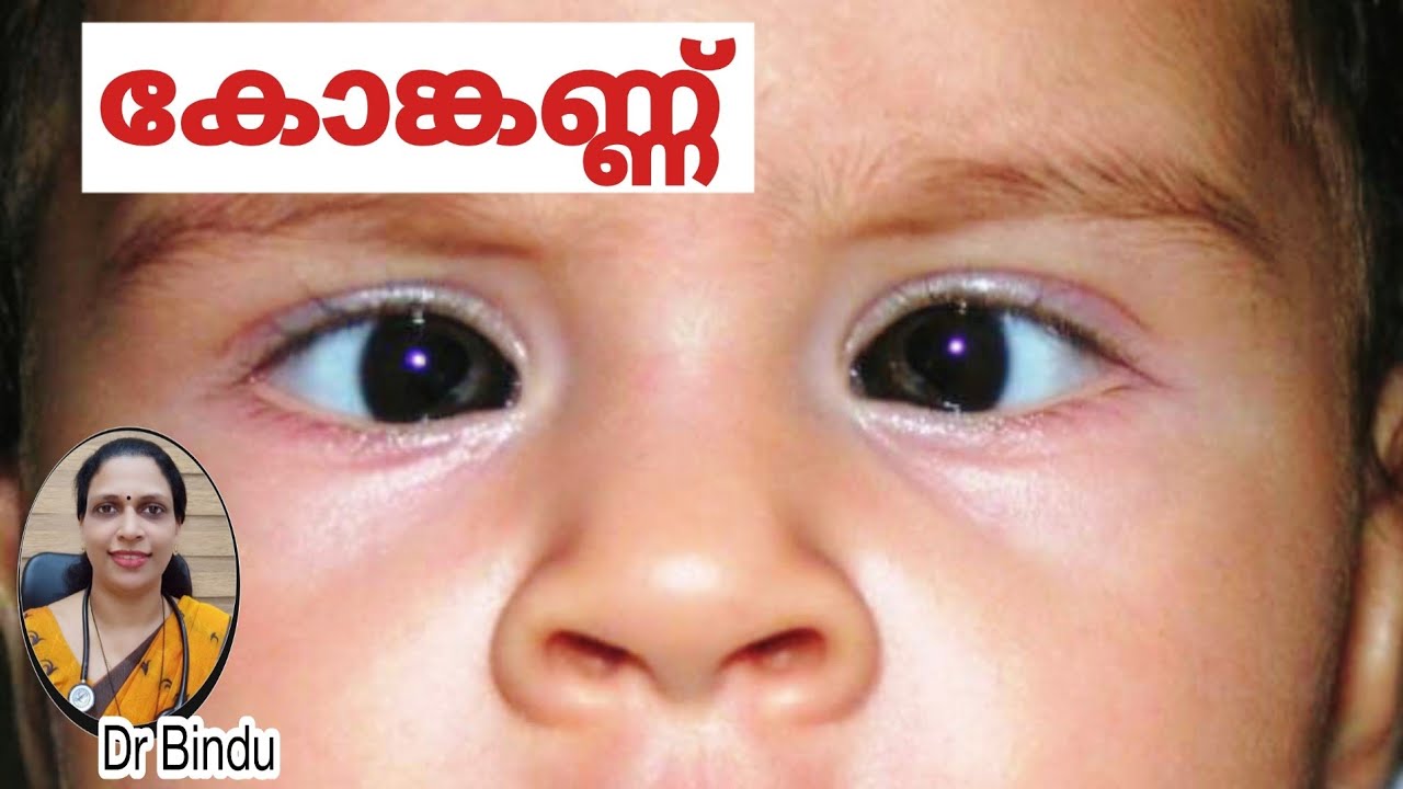 Squint in children/ കുട്ടികളിലെ കോങ്കണ്ണ് എന്തു ചെയ്യണം/parenting tips