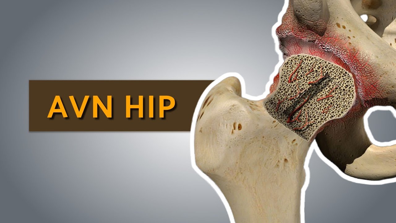 Hip Replacement Surgery After COVID-19: AVN Case Study