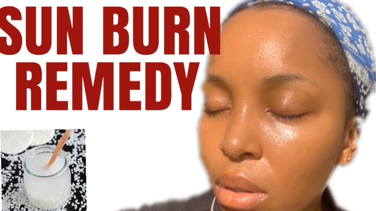 HOW TO TREAT SUNBURUN | THE BEST SUNBURN REMEDY | DIY