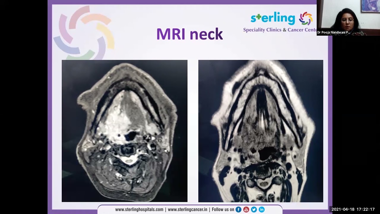 Dr. Pooja Nandwani Panel Discussion on Locally Advanced Oral Cancers