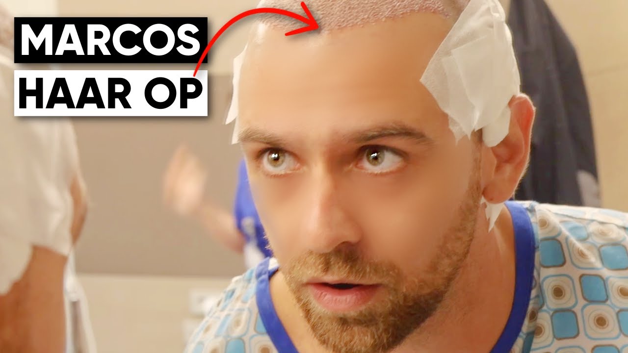 Marcos Haartransplantation | Erfahrung