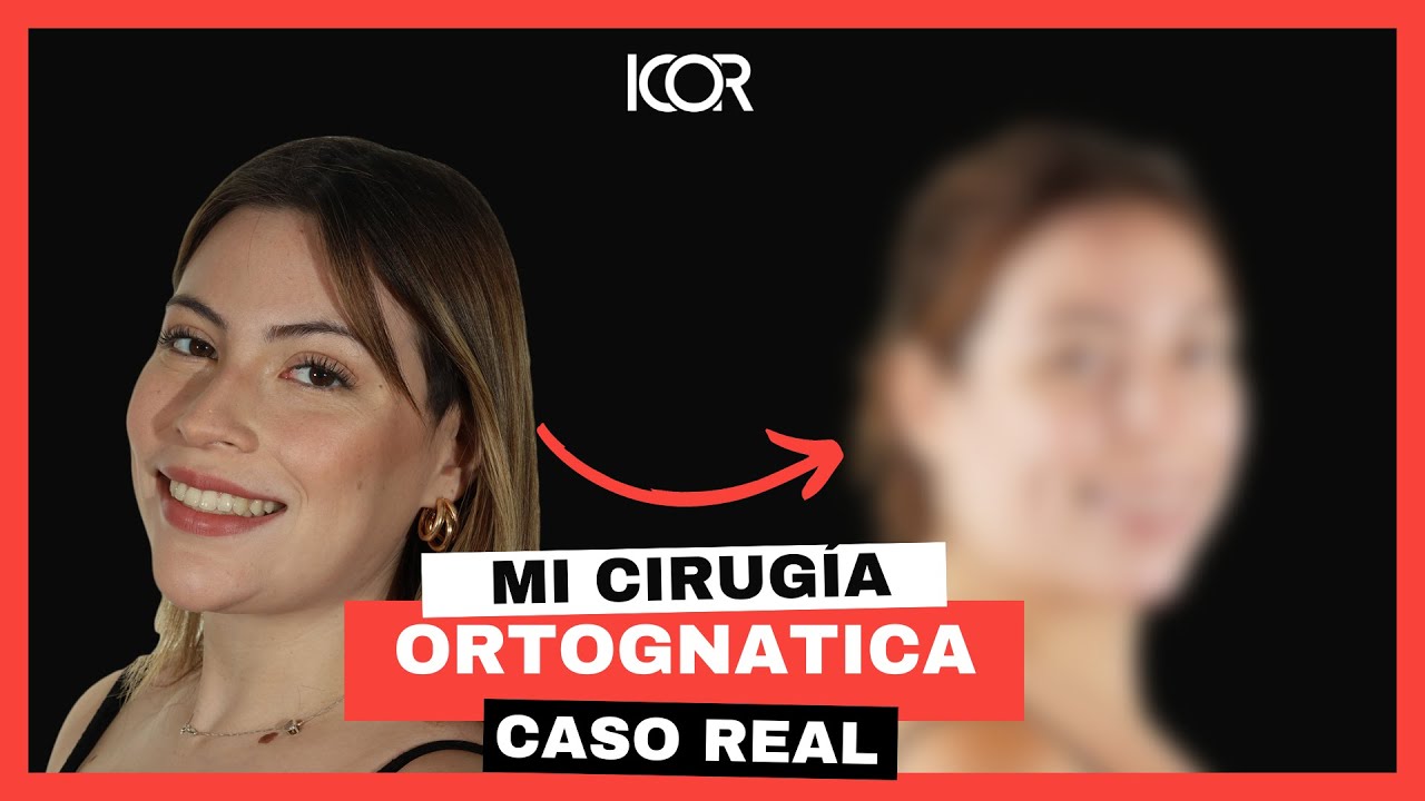 Testimonio Cirugía Ortognática Clase II + Prótesis + Ortodoncia.