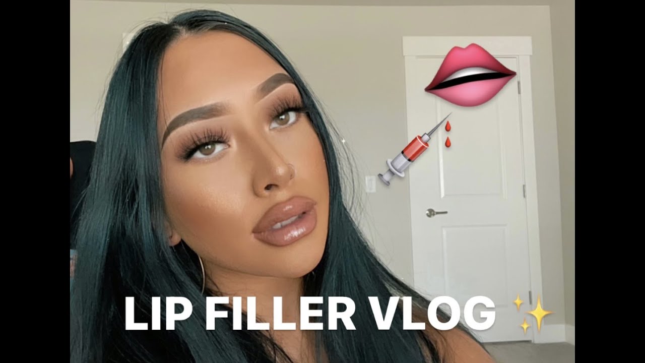 Irene's LIP FILLER VLOG!! *BEFORE, DURING, & AFTER PROCESS* 1 FULL SYRINGE