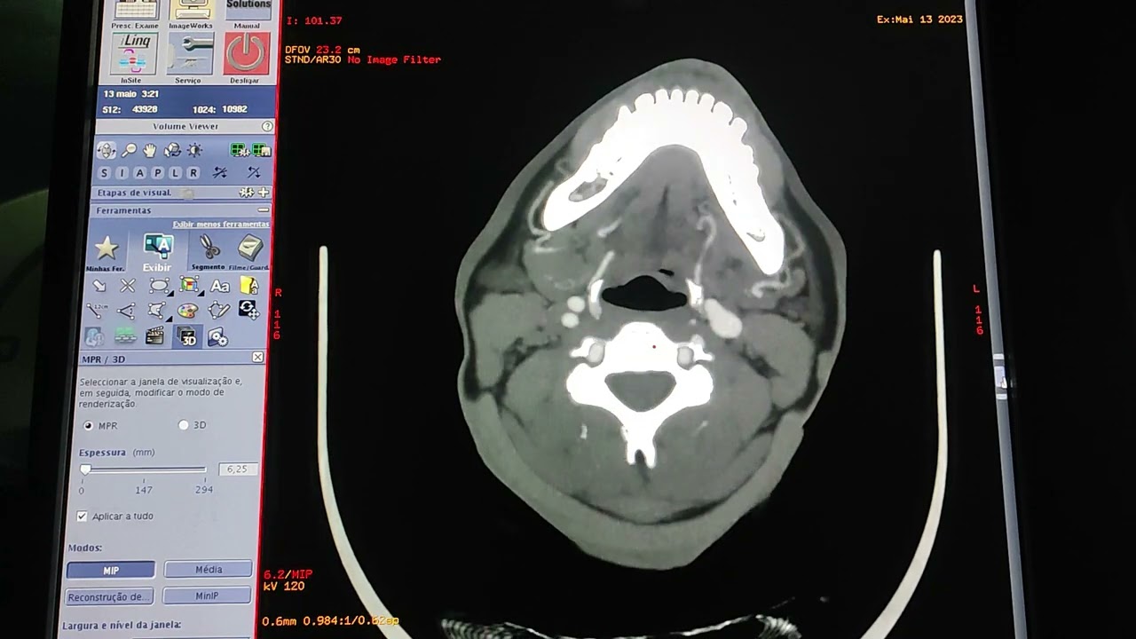 ANATOMIA SECCIONAL - ANGIOTC PESCOÇO E CRÂNIO