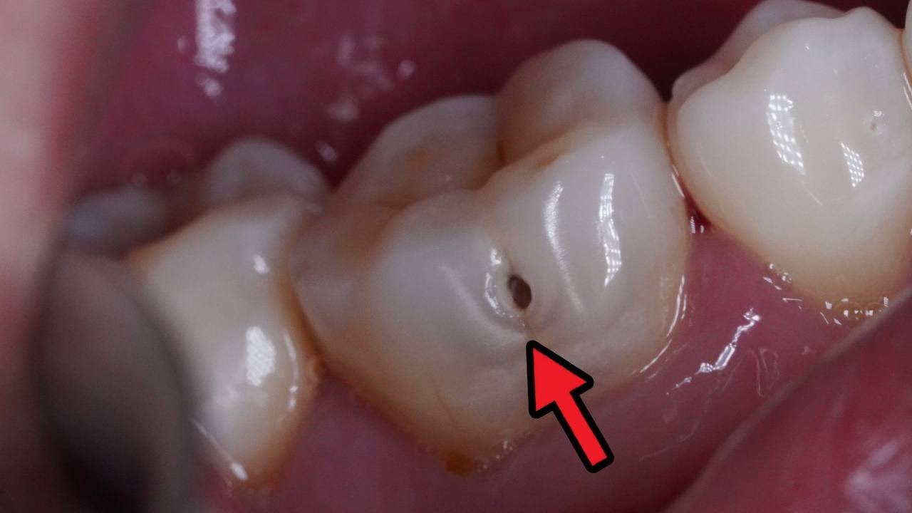 This Tooth Hole Looks Small, But Inside There Is Widening Damage.