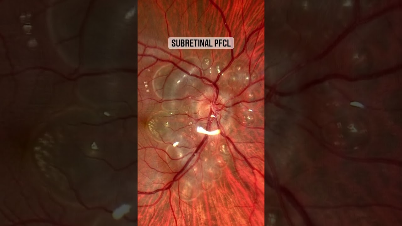 Subretinal PFCL after vitrectomy for retinal detachment *not mine! 🙌🏻 #retina #oftalmo #ophthalmol