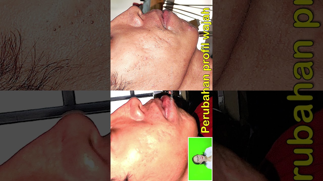 GIGI TONGGOS MUNDUR 8mm DALAM 10 BULAN BEHEL GIGI || PART 2 OF 6