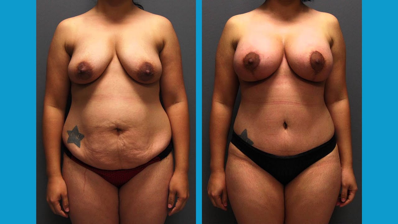 Dr. Kyle Song Explains the Mommy Makeover Procedure Irvine, CA.