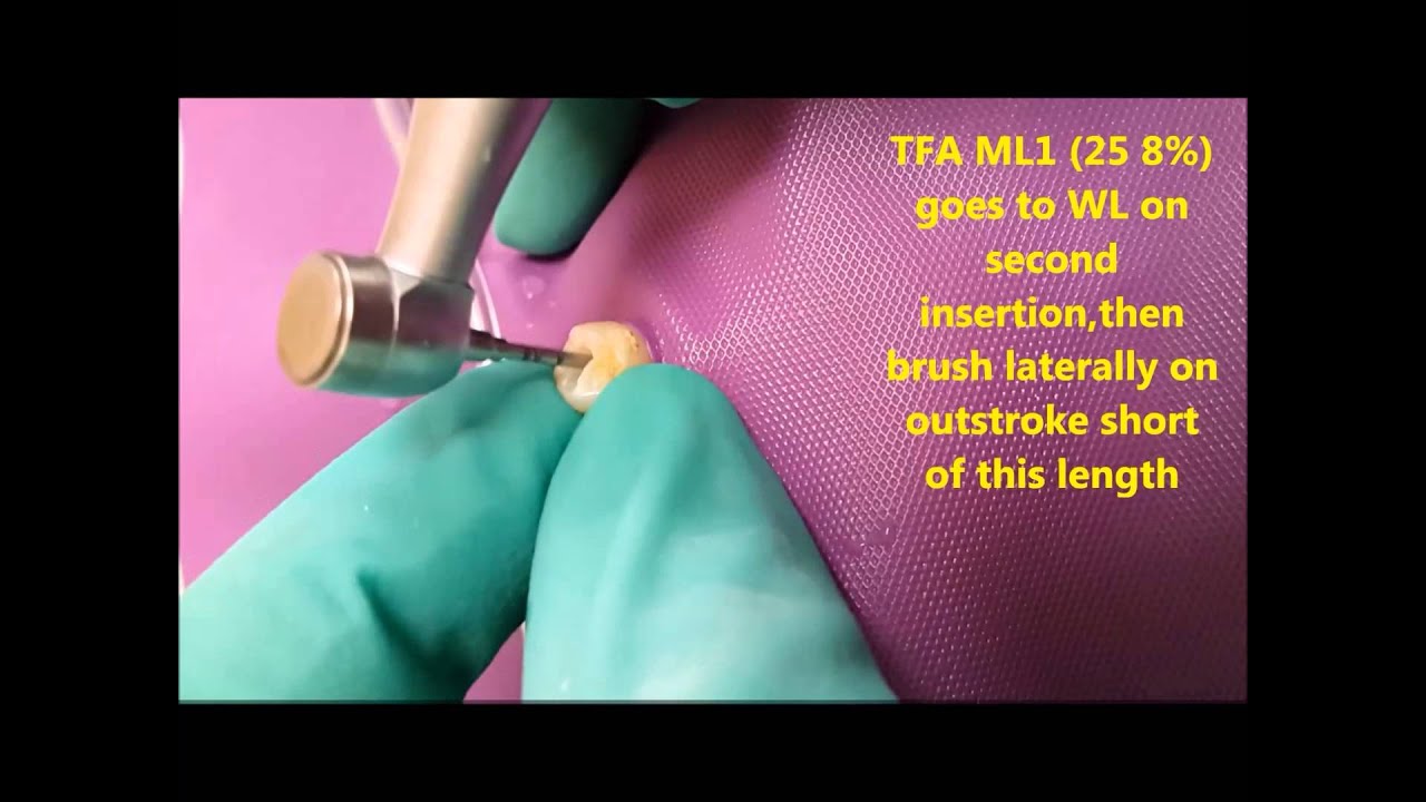 Axis Sybron Endo TFAdaptive files in lateral brushing motion