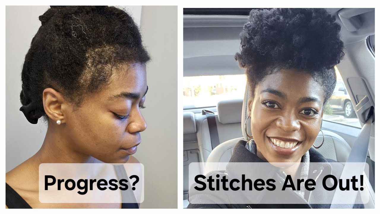 Stitches Are Out! - Hair Loss Update & Progress Photos - 4C Hair/Type 4 Natural Hair
