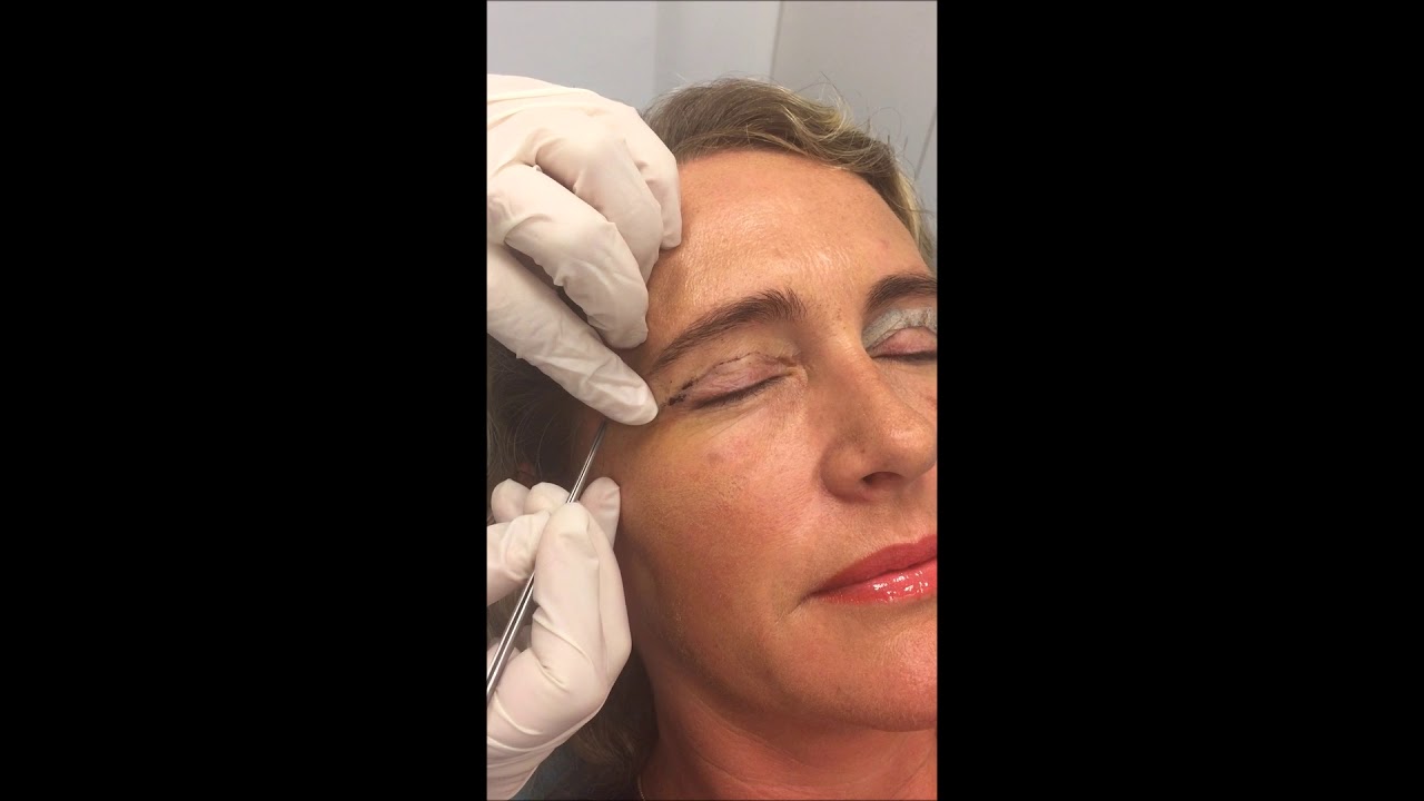 Daphne ooglidcorrectie hechtingen verwijderen