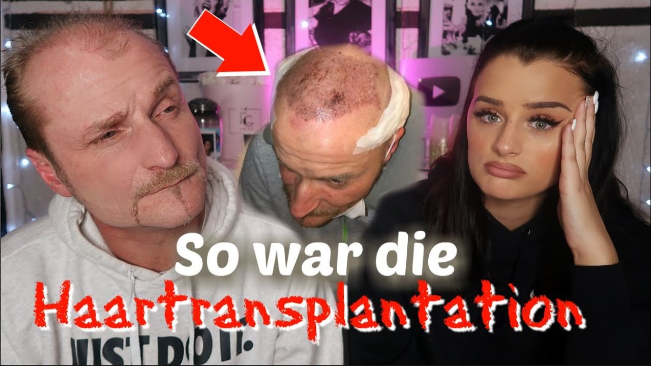 Wie ist es eine Haartransplantation in der T&uuml;rkei machen zu lassen?  |Cecelicious