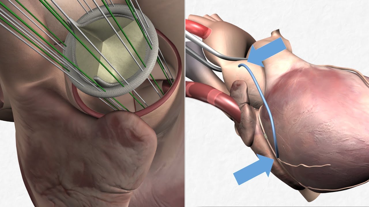 Aortenklappenersatz mit Bypass-Operation