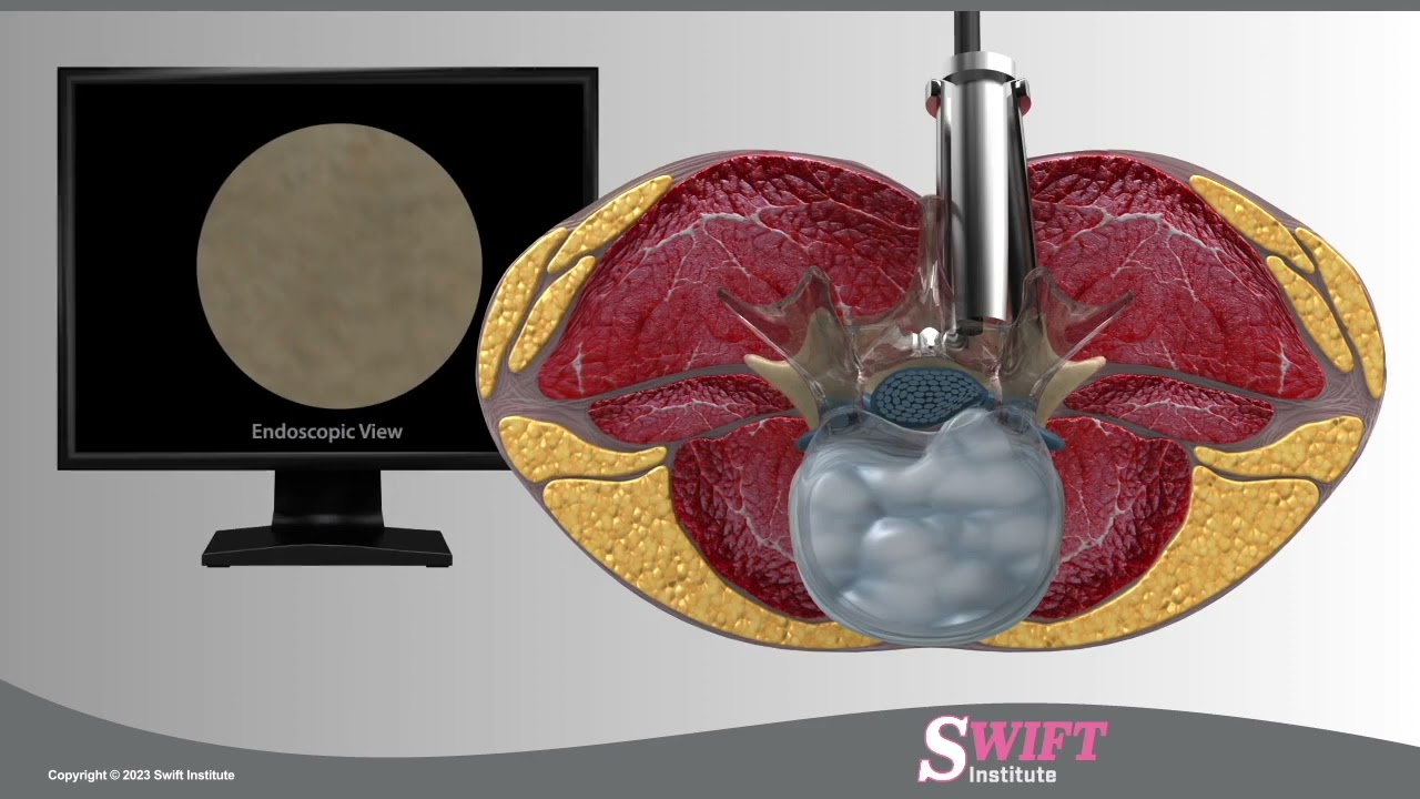 Reno Minimally Invasive Endoscopic Microdiscectomy - Swift Institute Spine Neurosurgery