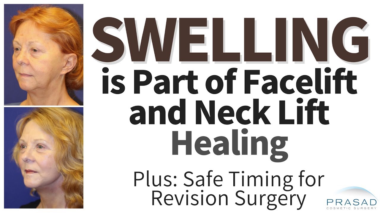 Why Swelling from Face and Neck Lifts Need to Resolve Before Revision, and Advanced Healing Methods