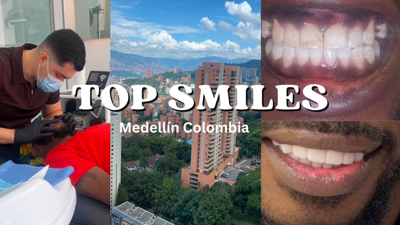 Ultimate Guide: Getting Porcelain Veneers at Top Smiles in Medellín, Colombia Step by Step Process