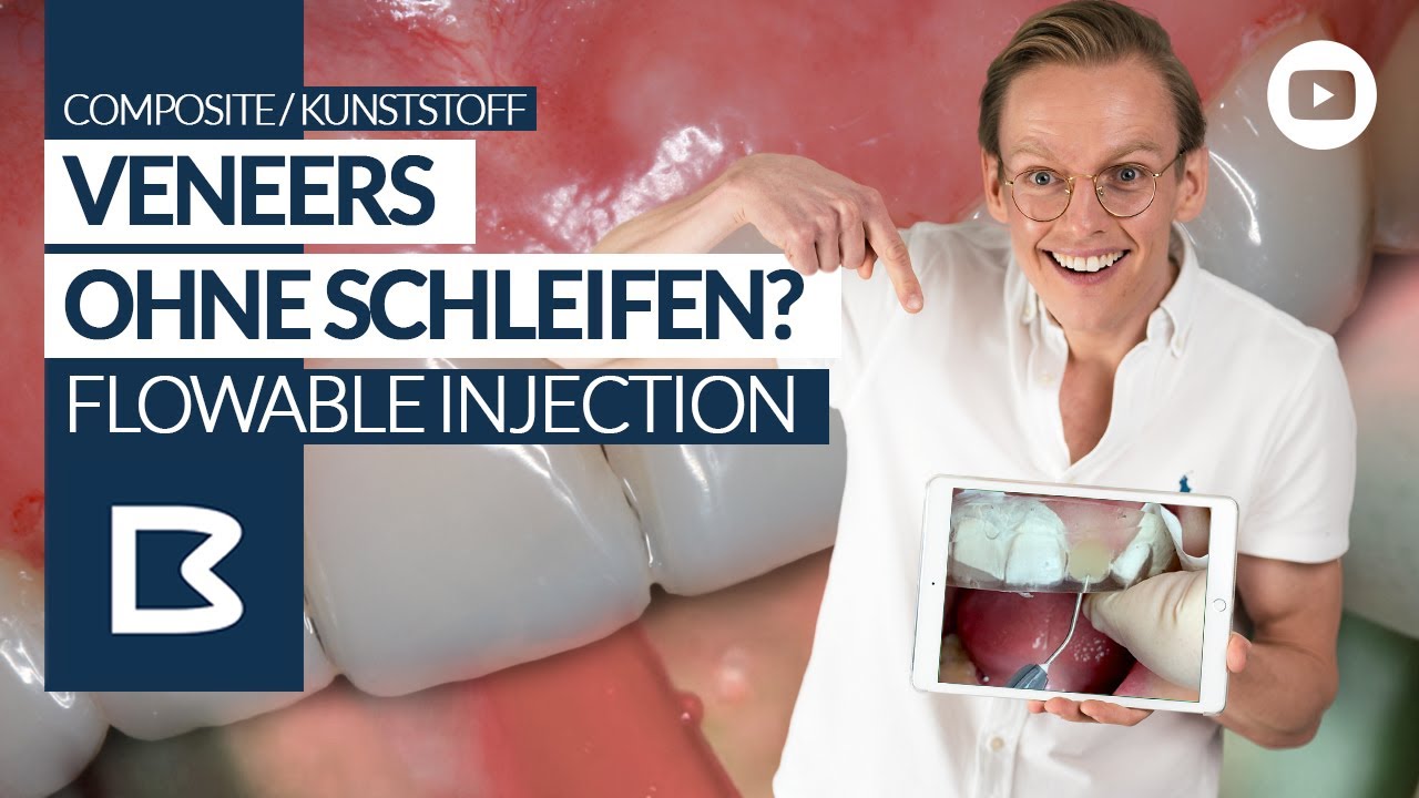 VENEERS (Vorher/Nachher) - OHNE Schleifen: Die Flowable Injection Technique!